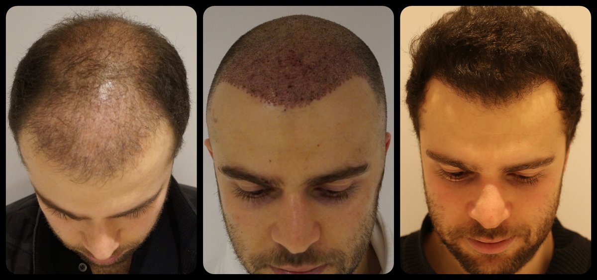 The Key Role of ISHRS in the Hair Transplant World