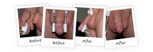 Penis girth and lenght enhancer ProExtender-before-and-after-reviews