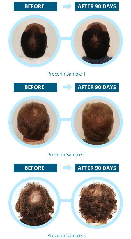 Procerin-real Results