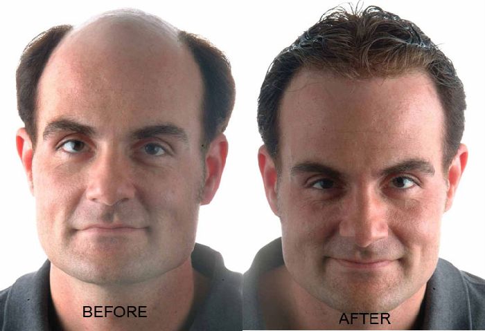 procerin results and reviews - hair regrowth