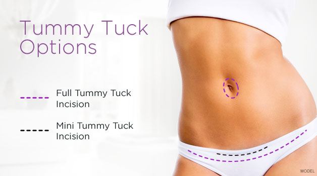 tummy-tuck