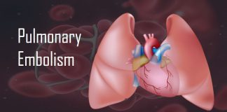 pulmonary-embolism