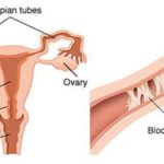 blocked fallopian tubes